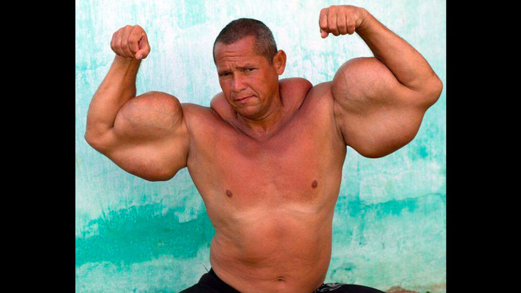 Muere el 'Popeye brasileño', conocido por inyectarse aceite mineral en los brazos Muere el 'Popeye brasileño', conocido por inyectarse aceite mineral en los brazos